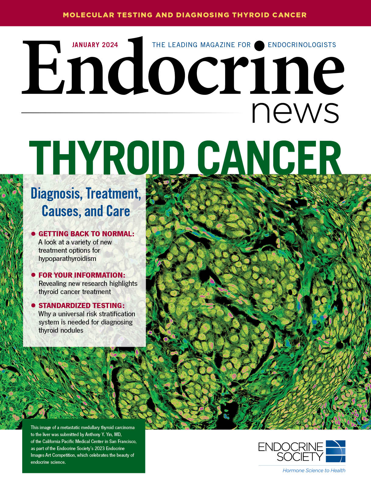 Molecular Testing and the Future of Diagnosing Thyroid Cancer ...