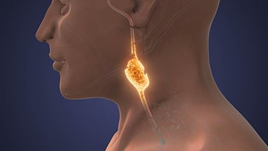 A Flexible Algorithm for a Variable Disease: Treating Pheochromocytoma and Paraganglioma