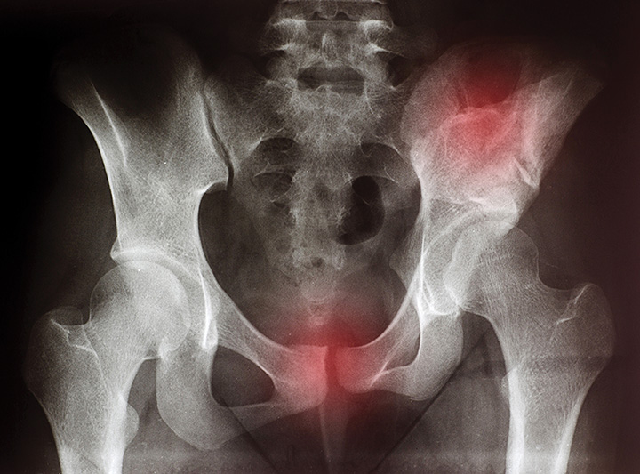 Hip Fracture