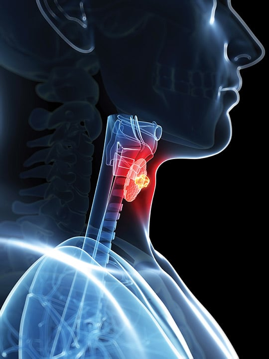 thyroid tumor image
